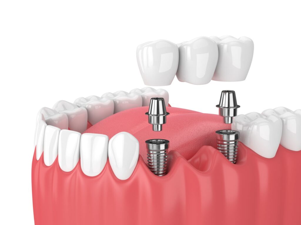 All-on-4 dental implants in Agoura Hills