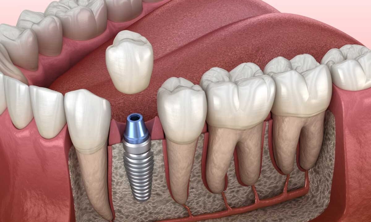 Dental Implants in Agoura Hills