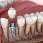 Dental Implants in Agoura Hills
