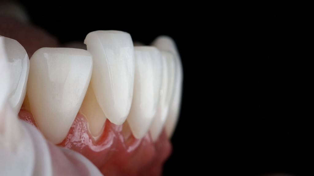 Dental Veneers in Agoura Hills 